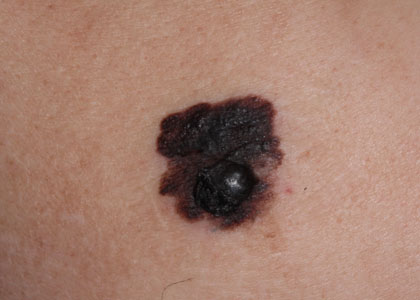 末端黒子黒色腫の症状