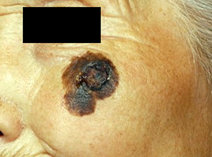 悪性黒色腫 メラノーマ がんの治療方法 がん治療について 岩手医科大学附属病院 がんセンター